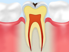 初期の虫歯の場合